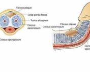 Peyronies Disease