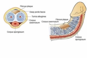 Peyronies Disease