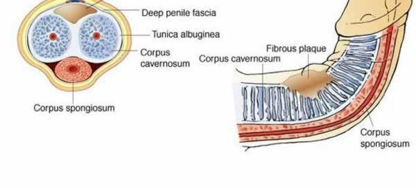 Peyronies Disease