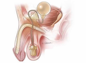 Penile Implants Dr. Tajkarimi