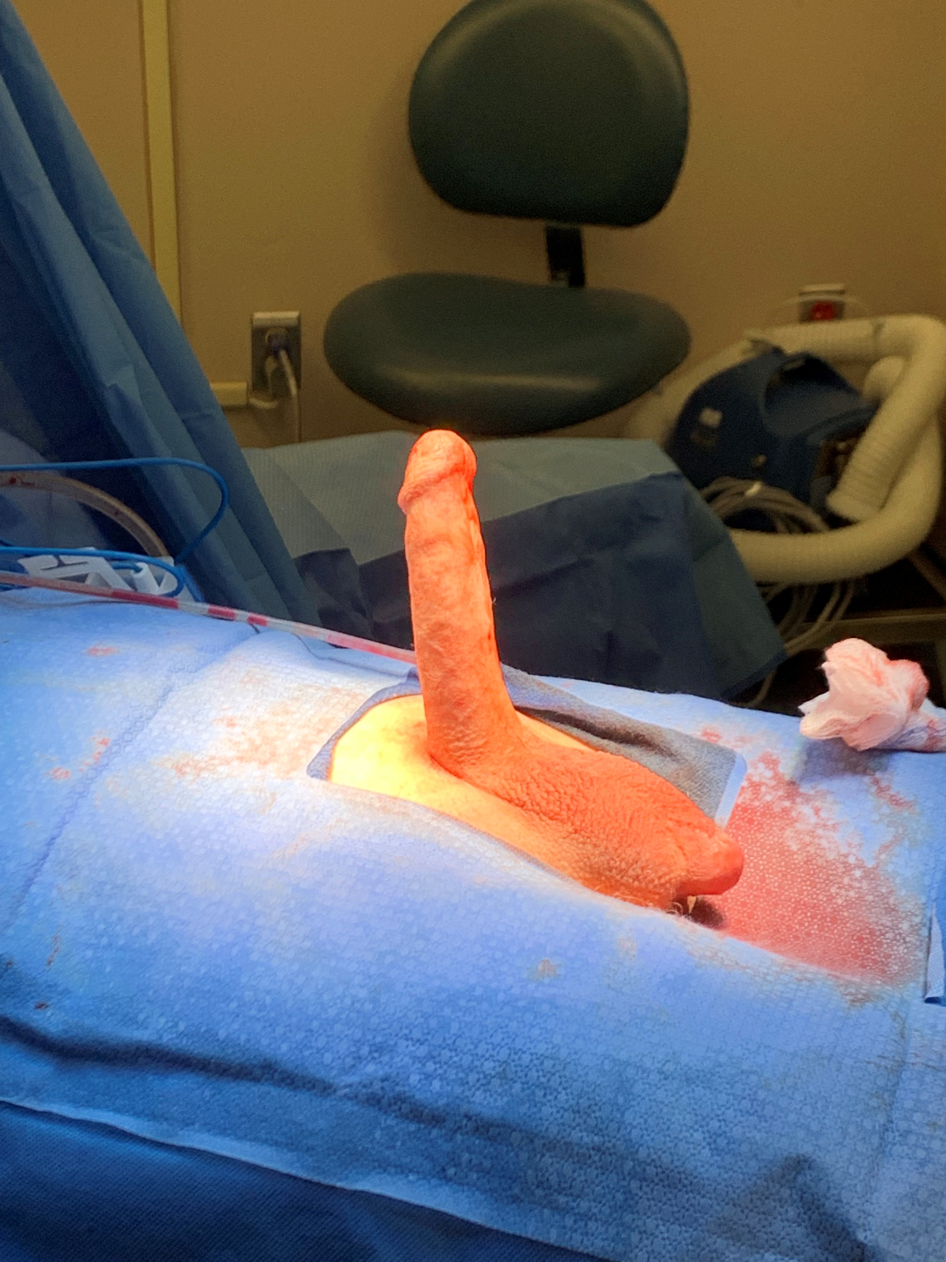 Slideshow bmf prosthetic penis.